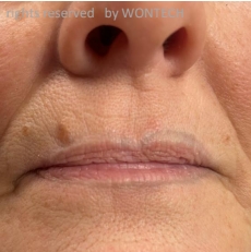 Case Review PicoAlex After