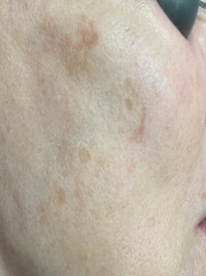 Case Review PicoAlex Before