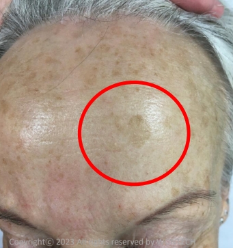 Case Review PicoAlex Before