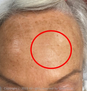 Case Review PicoAlex After