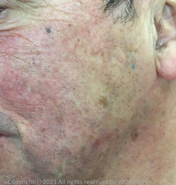 Case Review PicoAlex Before