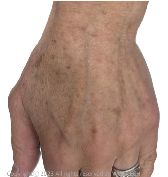 Case Review PicoAlex Before