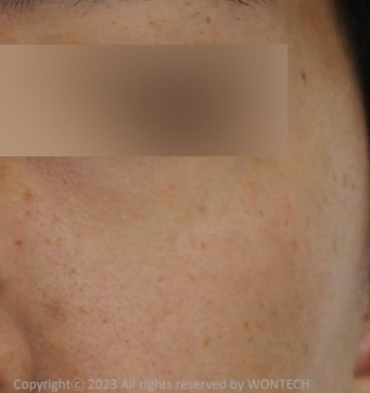 Case Review PicoAlex Before