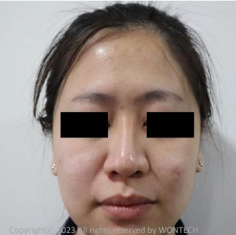 Case Review PicoAlex Before