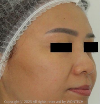 Case Review PicoAlex Before