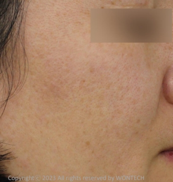 Case Review PicoAlex After