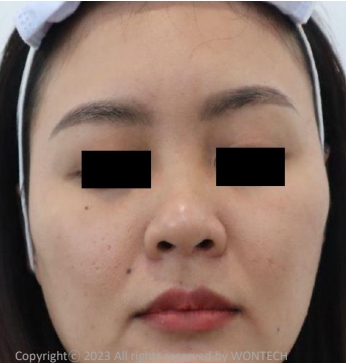 Case Review PicoAlex After