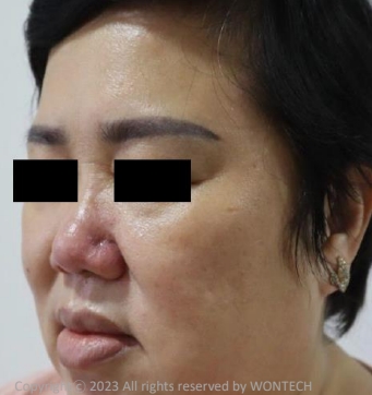 Case Review PicoAlex Before