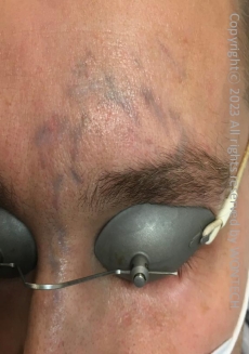 Case Review PicoAlex Before