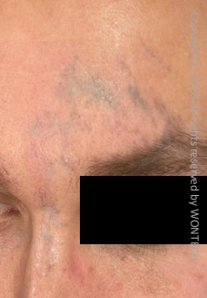 Case Review PicoAlex After