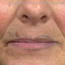 Case Review PicoAlex Before