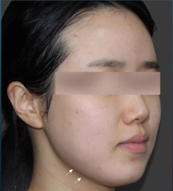 Case Review Oligio Immediately after