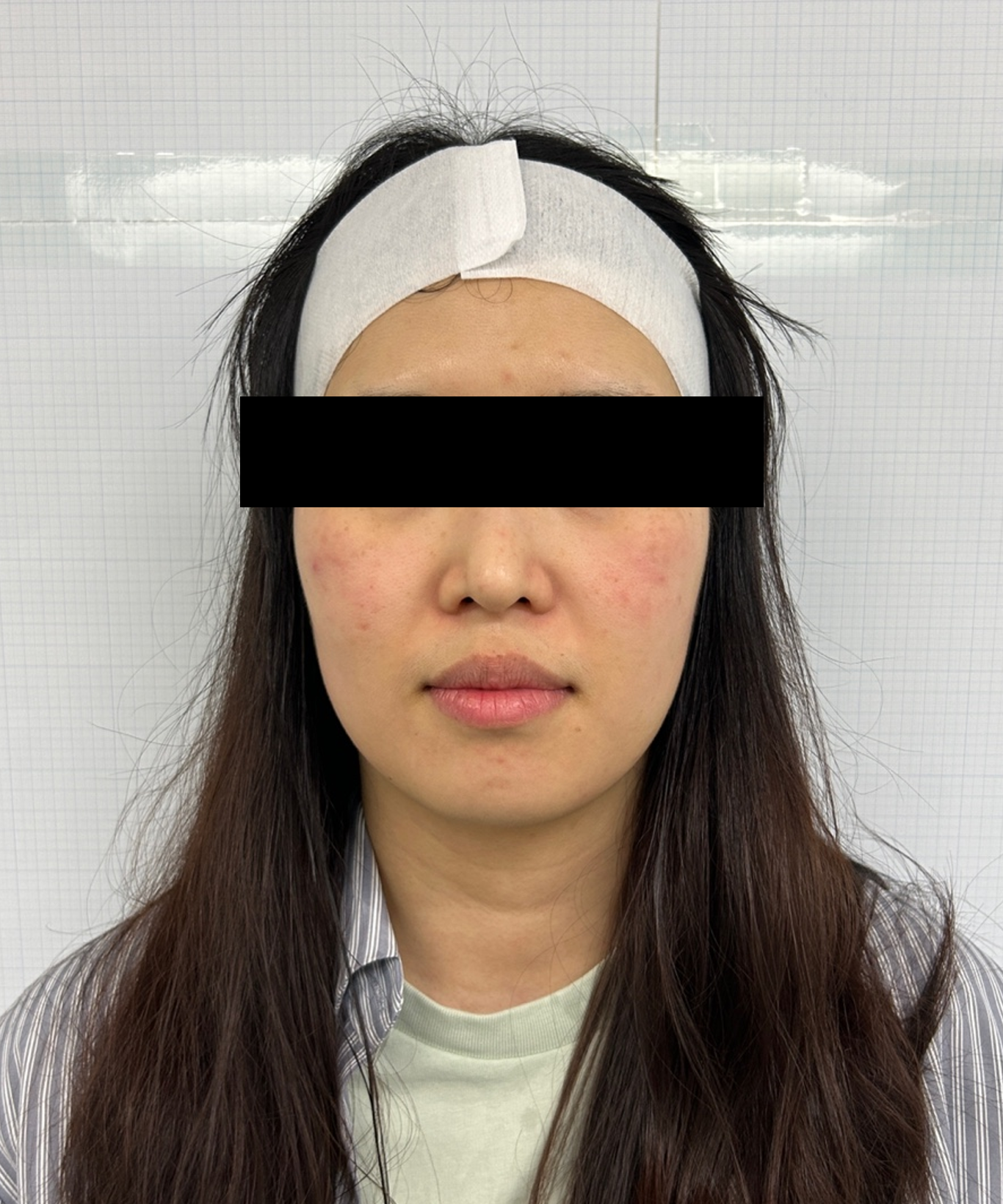 Case Review Oligio Immediately after