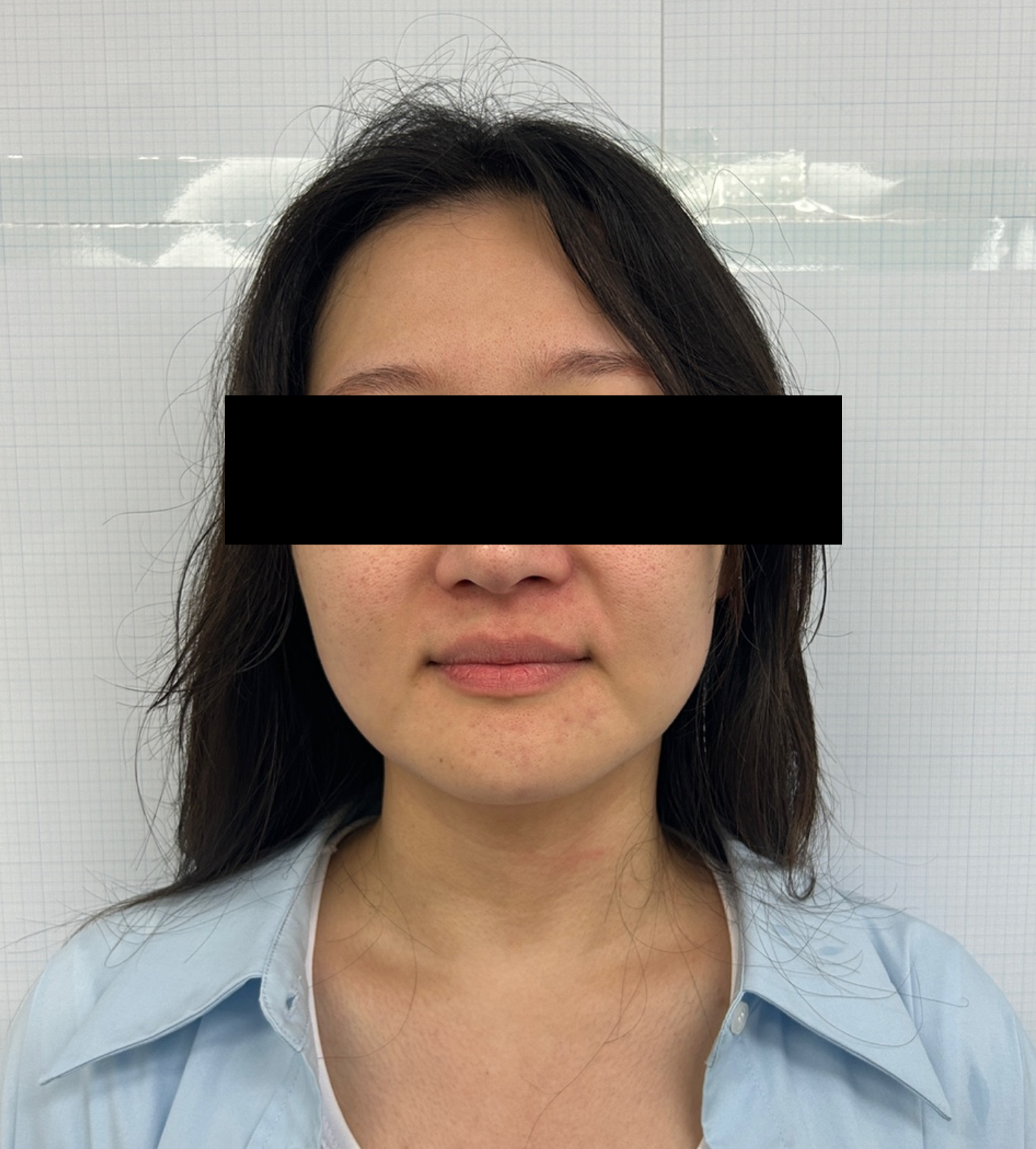 Case Review Oligio Immediately after