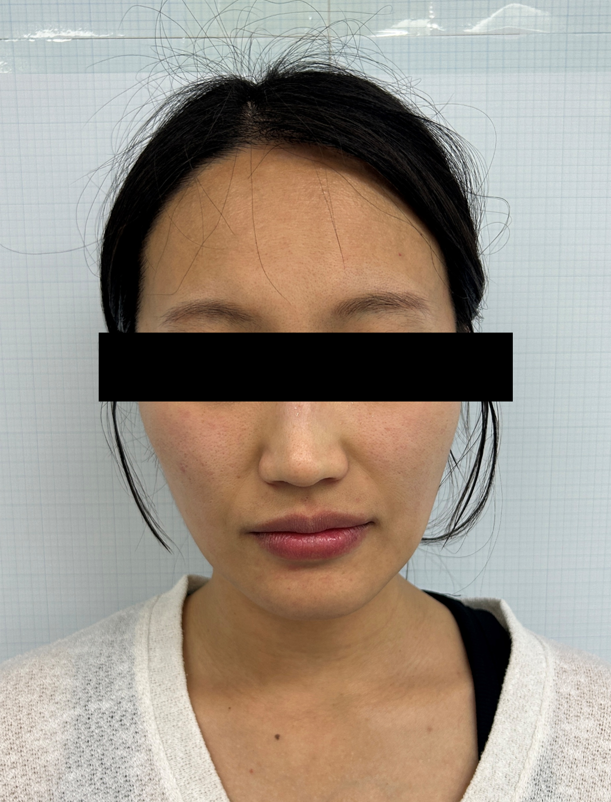 Case Review Oligio Immediately after