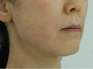 Case Review PicoAlex After