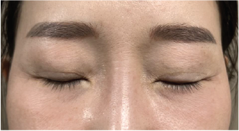 Case Review PicoAlex Before