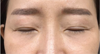 Case Review PicoAlex After