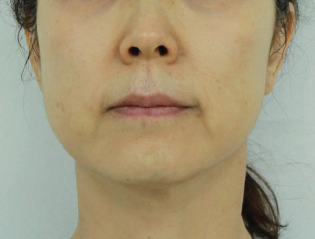 Case Review PicoAlex After