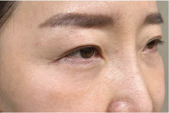 Case Review PicoAlex After