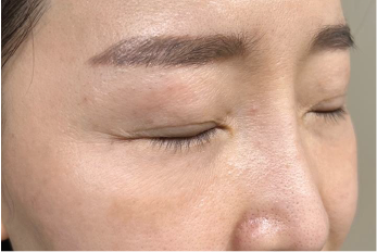 Case Review PicoAlex After