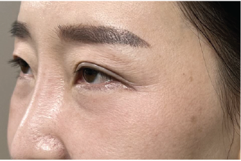 Case Review PicoAlex Before