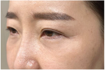 Case Review PicoAlex After