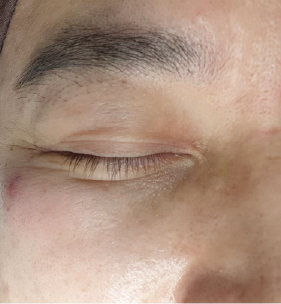 Case Review PicoAlex Before