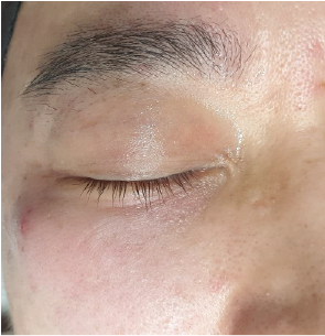 Case Review PicoAlex After