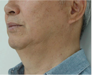 Case Review PicoAlex Before