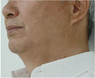 Case Review PicoAlex After