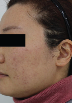 Case Review PicoAlex Before