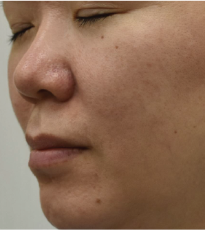 Case Review PicoAlex After