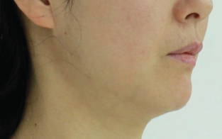 Case Review PicoAlex After