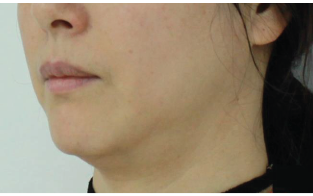 Case Review PicoAlex Before