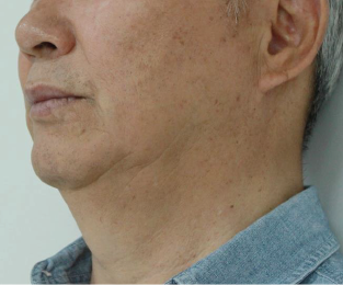 Case Review PicoAlex Before