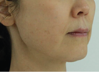 Case Review PicoAlex Before