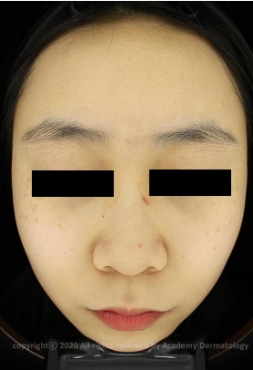 Case Review PicoAlex Before