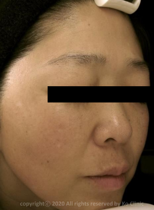 Case Review PicoAlex Before