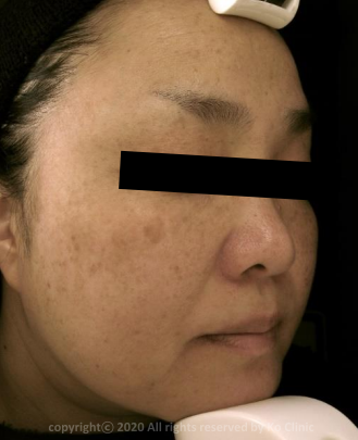 Case Review PicoAlex After