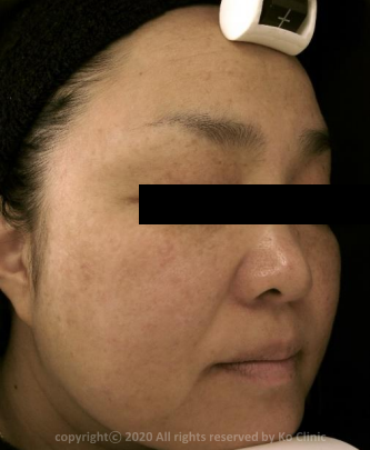 Case Review PicoAlex Before