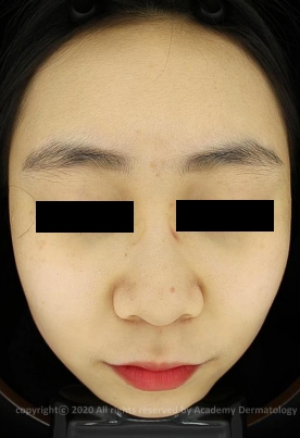 Case Review PicoAlex After