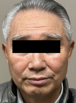 Case Review PicoAlex Before