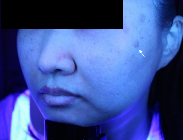 Case Review PicoAlex Before