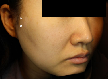 Case Review PicoAlex After