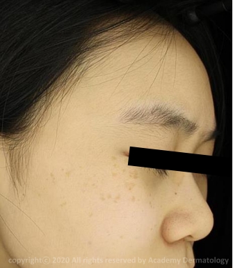 Case Review PicoAlex Before