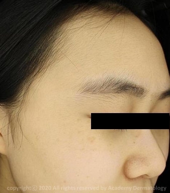 Case Review PicoAlex After