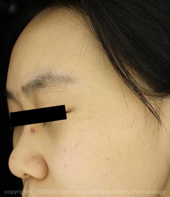 Case Review PicoAlex Before