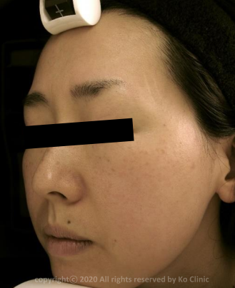 Case Review PicoAlex After