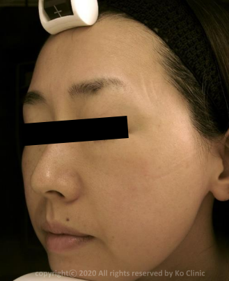 Case Review PicoAlex Before